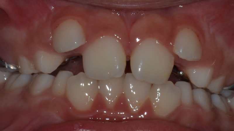 caso-clinico-ortodonzia-fissa-2